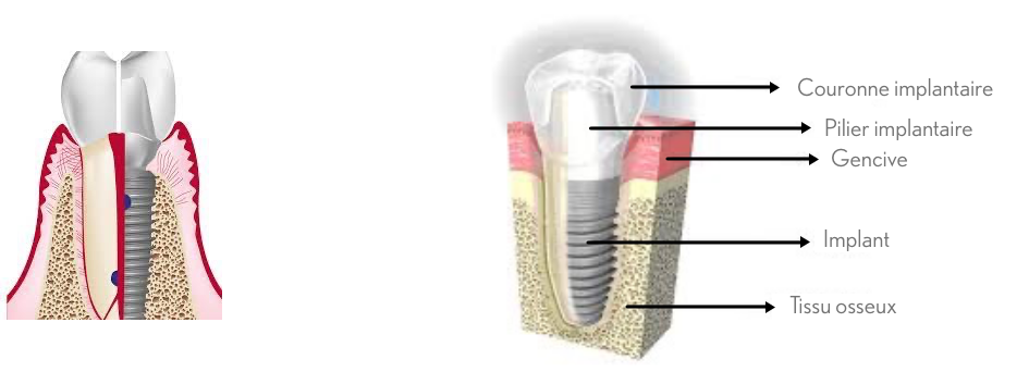 Voici un schéma qui vous explique à quoi ressemble un implant pour l'implantologie dentaire effectuée au cabinet du docteur Barbara Saiman à Marseille.