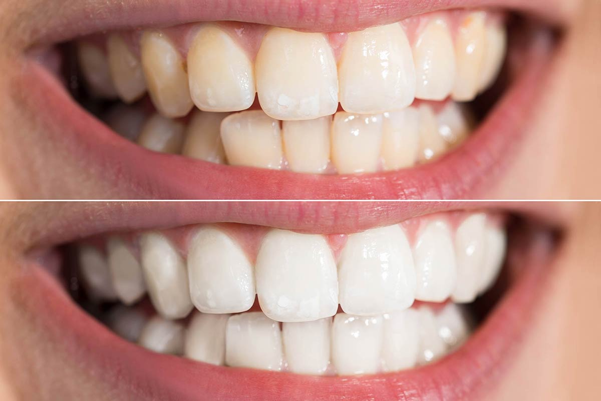 Voici le résultat avant et après le blanchiment dentaire à Marseille par le dentiste Barbara Saiman.