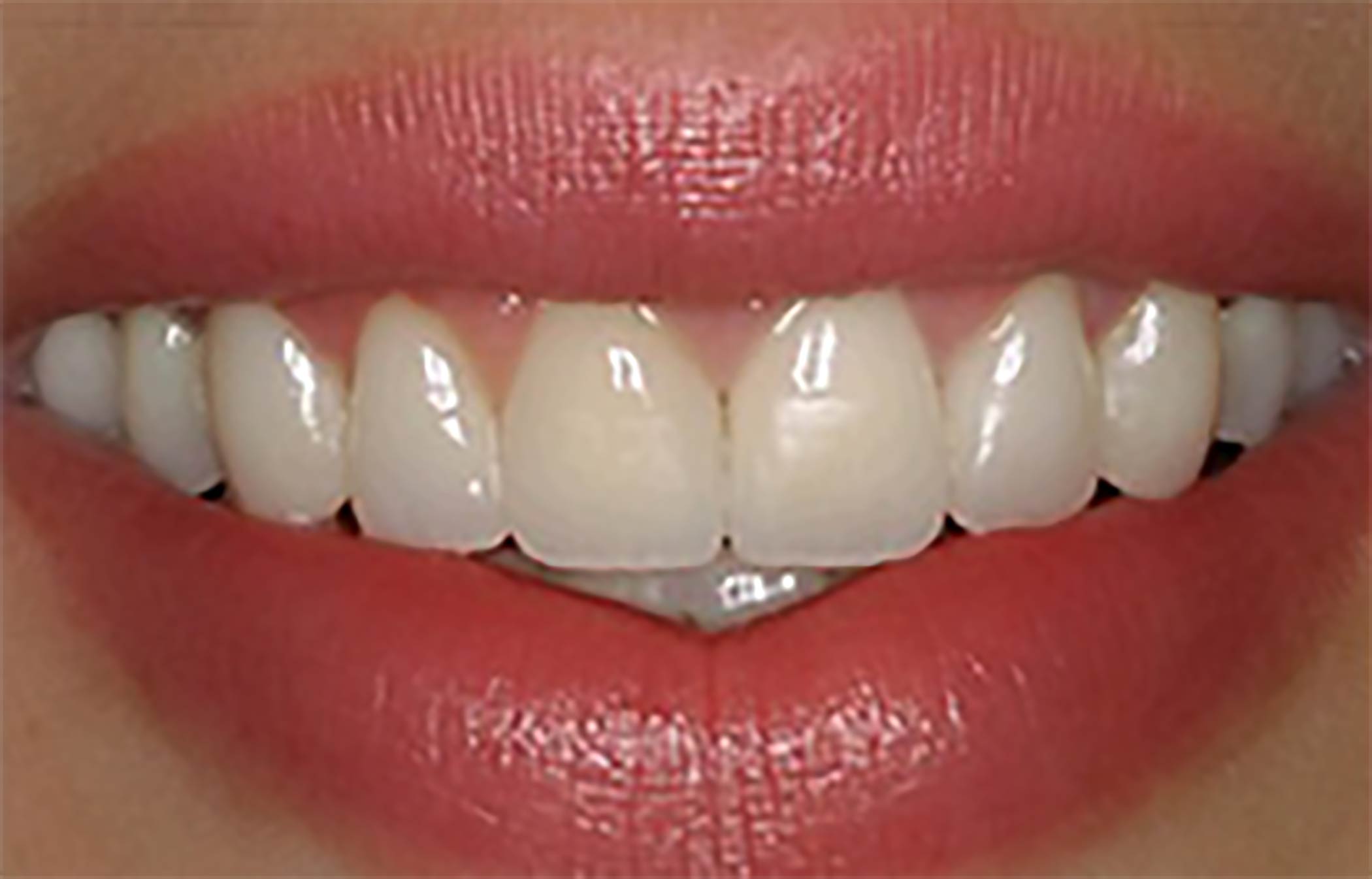 Voici le résultat après la pose de facettes dentaire à Marseille par le dentiste Barbara Saiman.