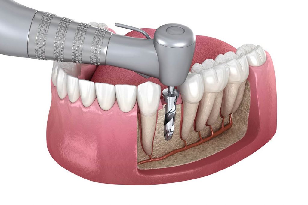 Découvrez la deuxième étape de l'implantologie dentaire.